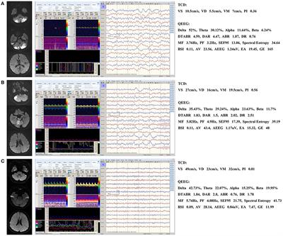 Transcranial Doppler Combined With Quantitative Electroencephalography Brain Function Monitoring for Estimating the Prognosis of Patients With Posterior Circulation Cerebral Infarction